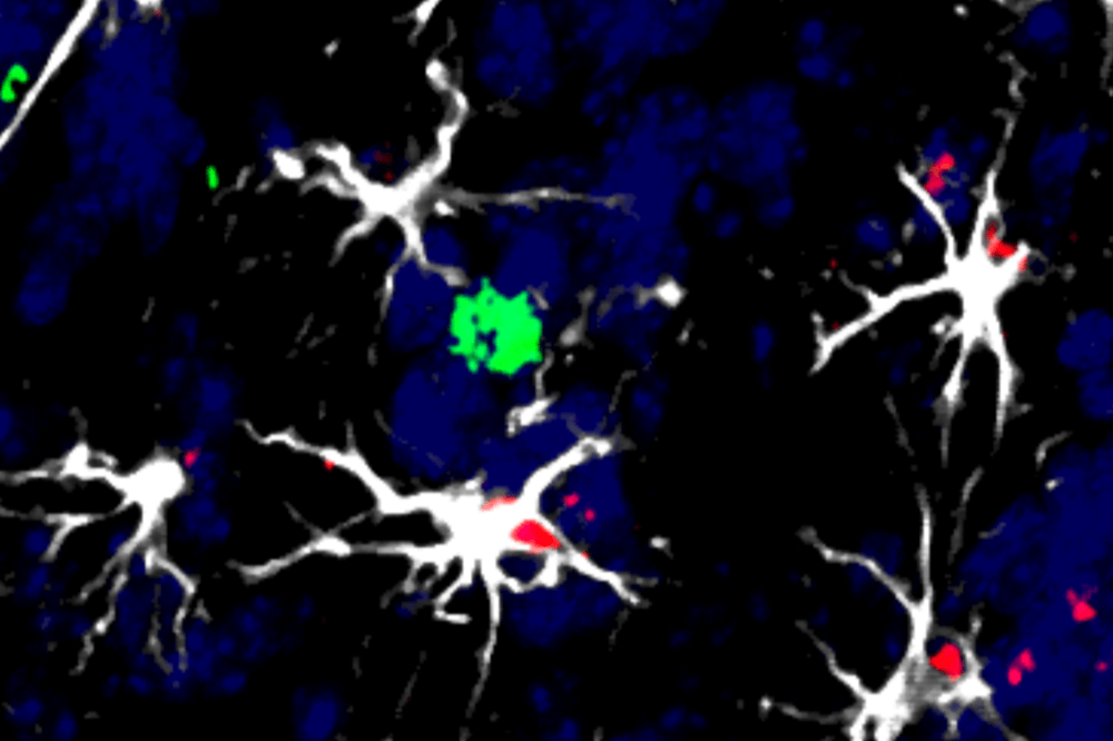 CNIO proposes new treatment for brain metastases using immunotherapy