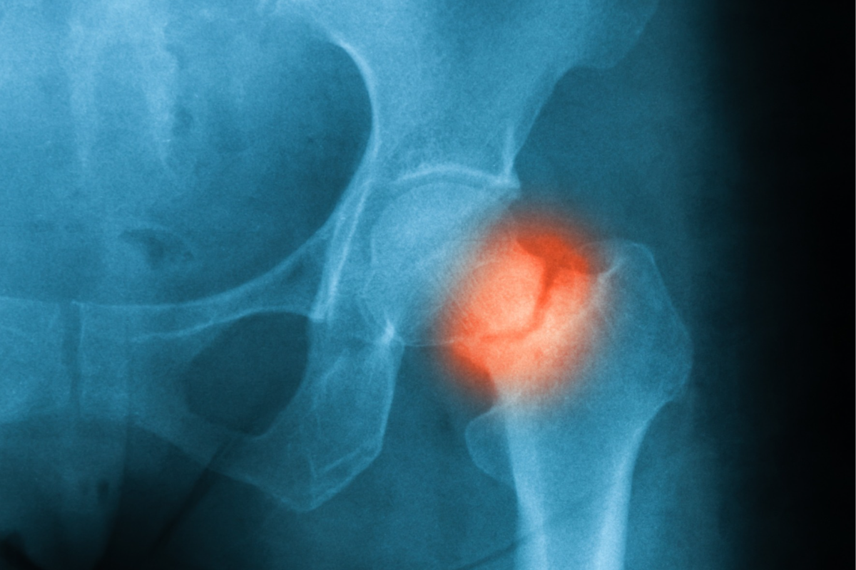 Intravenous bisphosphonate is more effective than oral bisphosphonate in preventing hip fractures.